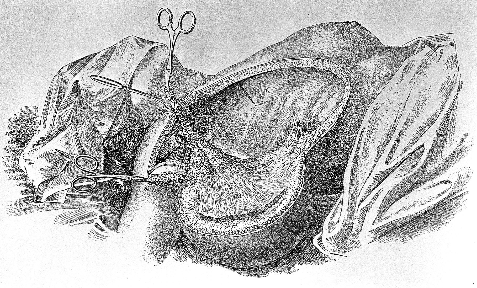 Halsted developed nerve-block anesthesia by injecting cocaine into his own arm, and into the arms of his medical students. He emerged addicted to cocaine, switched to morphine to wean off, and stayed on morphine for the rest of his surgical career. Nineteenth-century surgical illustration