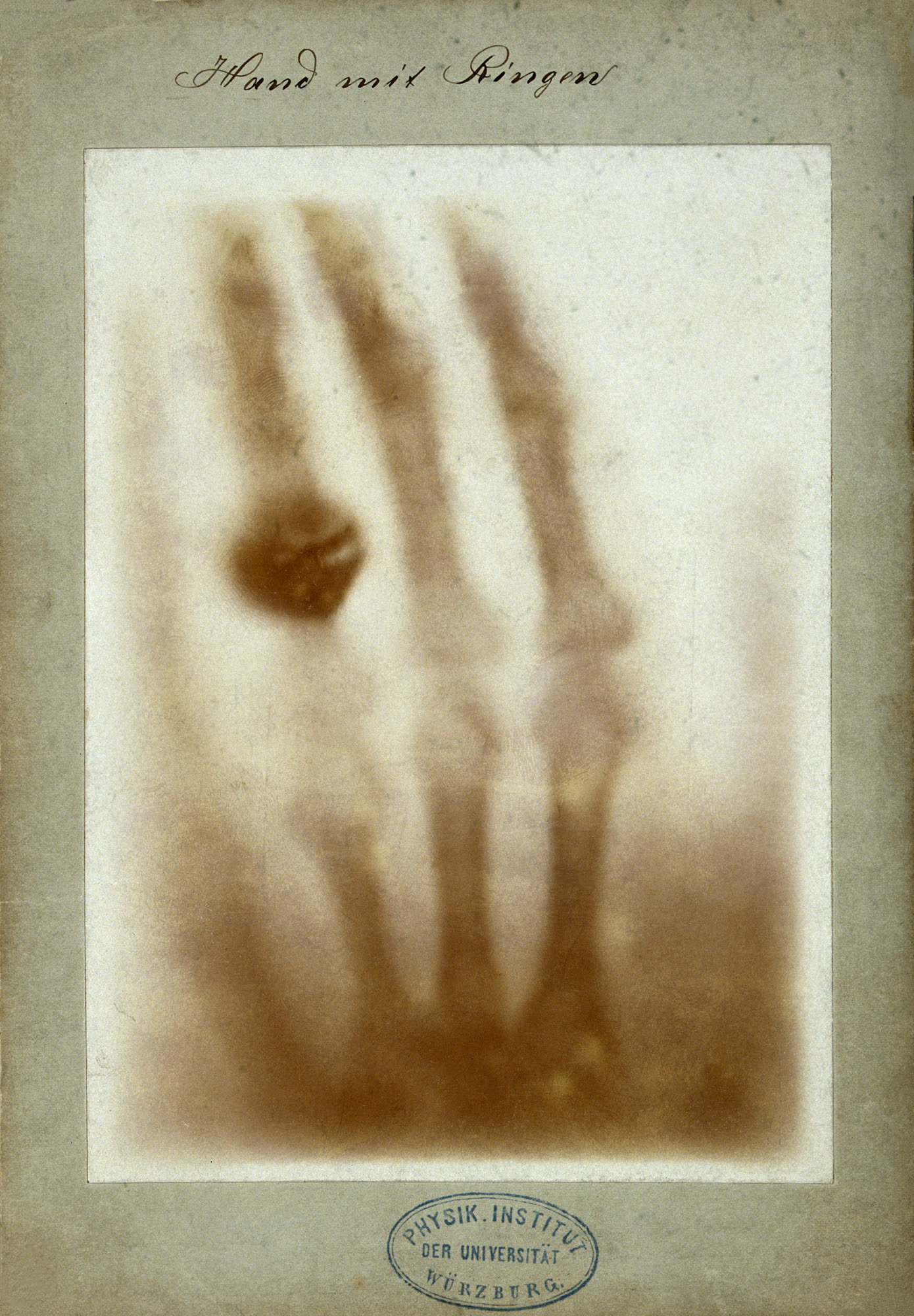 Röntgen's X-ray of his wife's hand, 22 December 1895